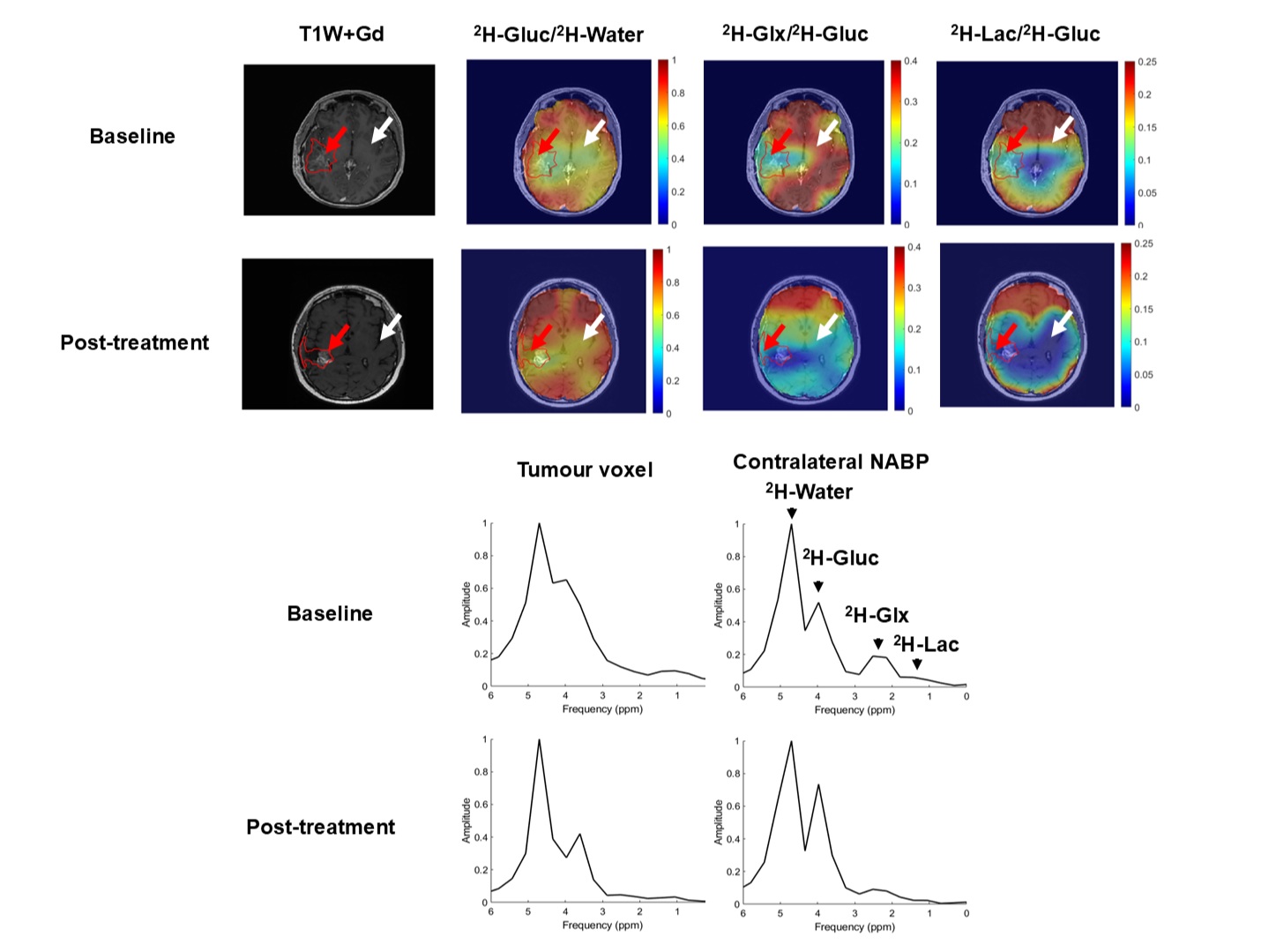 Representative DMI data from a patient with a high-grade glioma. DMI ratio maps pre- and post-treatment show spatial metabolic changes. Deuterium spectra from the tumor and contralateral NABP demonstrate metabolic differences and therapeutic effects.