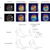 Representative DMI data from a patient with a high-grade glioma. DMI ratio maps pre- and post-treatment show spatial metabolic changes. Deuterium spectra from the tumor and contralateral NABP demonstrate metabolic differences and therapeutic effects.