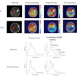 Representative DMI data from a patient with a high-grade glioma. DMI ratio maps pre- and post-treatment show spatial metabolic changes. Deuterium spectra from the tumor and contralateral NABP demonstrate metabolic differences and therapeutic effects.