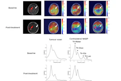 Representative DMI data from a patient with a high-grade glioma. DMI ratio maps pre- and post-treatment show spatial metabolic changes. Deuterium spectra from the tumor and contralateral NABP demonstrate metabolic differences and therapeutic effects.