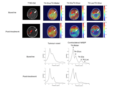 Representative DMI data from a patient with a high-grade glioma. DMI ratio maps pre- and post-treatment show spatial metabolic changes. Deuterium spectra from the tumor and contralateral NABP demonstrate metabolic differences and therapeutic effects.