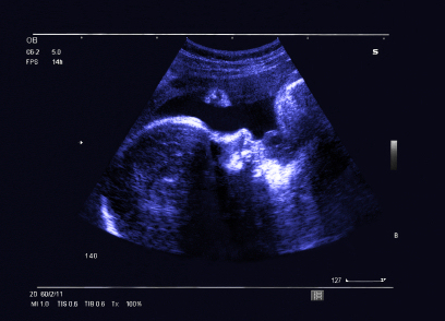 Fetal Ultrasound