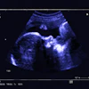 Fetal Ultrasound