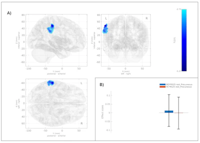 SBC group-level analysis results showing a 3D glass-brain visualization of clusters identified via GLM analysis (top row within subplots) and the effect sizes (beta values) of IBD and HC within the identified clusters (bottom row, right corner). Differences in connectivity are shown for the precuneus as the seed region.