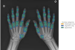 Overlap between manual (radiologist) and semiautomatic (algorithm) segmentations of hand joints on a standard posteroanterior radiograph. Orange overlay indicates manual radiologist segmentations, blue overlay shows algorithm segmentations, and green overlay indicates consistent regions between both methods.