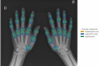 Overlap between manual (radiologist) and semiautomatic (algorithm) segmentations of hand joints on a standard posteroanterior radiograph. Orange overlay indicates manual radiologist segmentations, blue overlay shows algorithm segmentations, and green overlay indicates consistent regions between both methods.