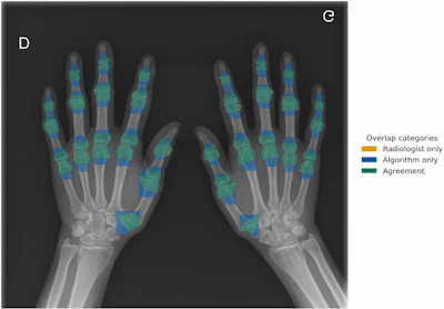 Overlap between manual (radiologist) and semiautomatic (algorithm) segmentations of hand joints on a standard posteroanterior radiograph. Orange overlay indicates manual radiologist segmentations, blue overlay shows algorithm segmentations, and green overlay indicates consistent regions between both methods.