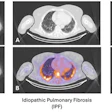 Sample images from each participant group: A: CT only; B: fused Tc-99m maraciclatide SPECT/CT.