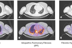 Sample images from each participant group: A: CT only; B: fused Tc-99m maraciclatide SPECT/CT.