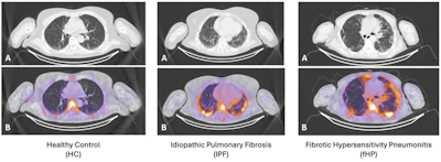 Sample images from each participant group: A: CT only; B: fused Tc-99m maraciclatide SPECT/CT.