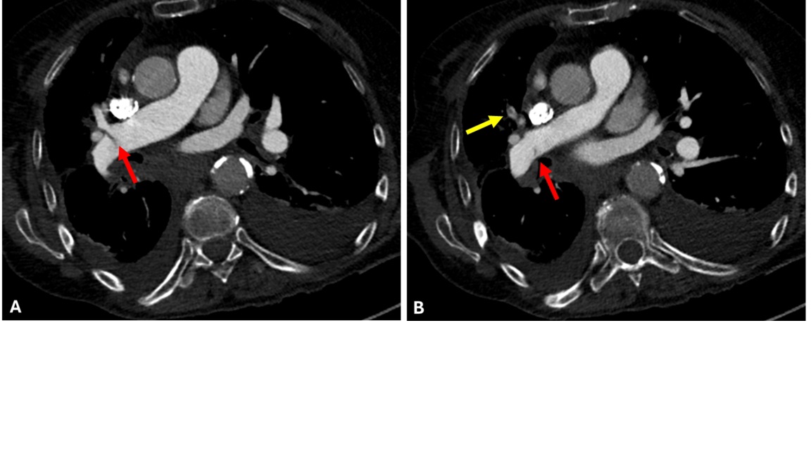 Case example of a false-negative AI result. An 85-year-old female presented to the emergency department with dyspnea. Axial 0.625-mm from CT pulmonary angiography examination with contrast (CTPA) images demonstrate a thin, linear right-sided filling defect extending from the right interlobar pulmonary artery (A and B, red arrows) into the right middle lobar artery (B, yellow arrow), consistent with acute pulmonary embolism (PE). The finding was described in the radiology report; however, the AI result was negative for PE. Adjudication was consistent with acute PE.