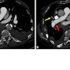 Case example of a false-negative AI result. An 85-year-old female presented to the emergency department with dyspnea. Axial 0.625-mm from CT pulmonary angiography examination with contrast (CTPA) images demonstrate a thin, linear right-sided filling defect extending from the right interlobar pulmonary artery (A and B, red arrows) into the right middle lobar artery (B, yellow arrow), consistent with acute pulmonary embolism (PE). The finding was described in the radiology report; however, the AI result was negative for PE. Adjudication was consistent with acute PE.