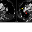 Case example of a false-negative AI result. An 85-year-old female presented to the emergency department with dyspnea. Axial 0.625-mm from CT pulmonary angiography examination with contrast (CTPA) images demonstrate a thin, linear right-sided filling defect extending from the right interlobar pulmonary artery (A and B, red arrows) into the right middle lobar artery (B, yellow arrow), consistent with acute pulmonary embolism (PE). The finding was described in the radiology report; however, the AI result was negative for PE. Adjudication was consistent with acute PE.