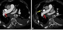 Case example of a false-negative AI result. An 85-year-old female presented to the emergency department with dyspnea. Axial 0.625-mm from CT pulmonary angiography examination with contrast (CTPA) images demonstrate a thin, linear right-sided filling defect extending from the right interlobar pulmonary artery (A and B, red arrows) into the right middle lobar artery (B, yellow arrow), consistent with acute pulmonary embolism (PE). The finding was described in the radiology report; however, the AI result was negative for PE. Adjudication was consistent with acute PE.