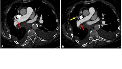 Case example of a false-negative AI result. An 85-year-old female presented to the emergency department with dyspnea. Axial 0.625-mm from CT pulmonary angiography examination with contrast (CTPA) images demonstrate a thin, linear right-sided filling defect extending from the right interlobar pulmonary artery (A and B, red arrows) into the right middle lobar artery (B, yellow arrow), consistent with acute pulmonary embolism (PE). The finding was described in the radiology report; however, the AI result was negative for PE. Adjudication was consistent with acute PE.