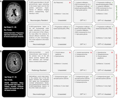 Sample cases. (A) The correct diagnosis was progressive multifocal leukoencephalopathy. Although GPT-4.1 suggested the correct diagnosis based on imaging findings from both the neurosurgery resident and the neuroradiologist, only the neurosurgery resident benefited from it, though their diagnostic confidence remained low. (B) The correct diagnosis was subependymal giant cell astrocytoma. Although GPT-4.1 suggested the correct diagnosis based on the imaging findings provided by the neuroradiologist, neither of the two readers benefited from it. Imaging descriptions were translated from German to English for illustration purposes.