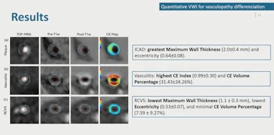 Ismrm2026 Balu Quantitative Features Ivw Mri