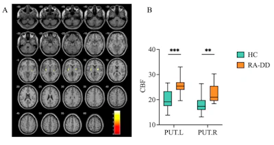 Figure A shows a statistical parametric map highlighting brain regions with significantly different cerebral blood flow (CBF) of rheumatoid arthritis patients with depressive disorder compared to healthy controls. Figure B shows the box plot comparing the mean CBF values extracted from the significant clusters identified in Figure A.