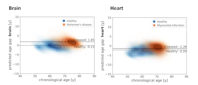 Predicted age gaps (= predicted age - chronological age) of the brain and heart across chronological age for a healthy test set (blue, upper row) and in comparison with a diseased subcohort (orange, lower row). Diseased subgroups are defined per organ (brain: patients developing Alzheimer's disease; heart: patients developing myocardial infarction).