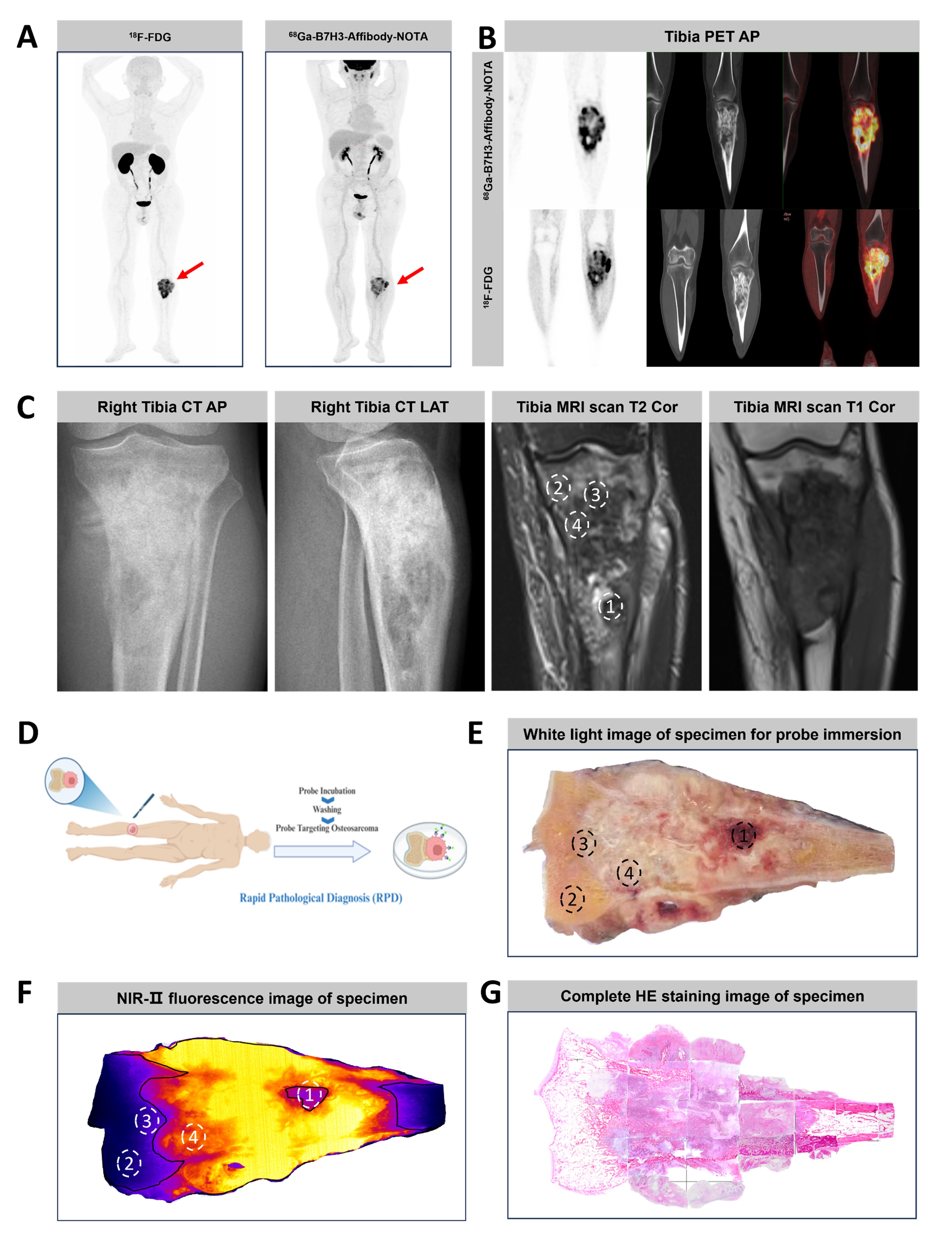(A-C) Representative whole-body maximum-intensity projection images and regional fused PET/CT images from three histologically confirmed osteosarcoma patients who underwent paired [68Ga]Ga-B7-H3-BCH PET/CT and 18F-FDGE PET/CT within seven days. (D) Multimodal imaging evaluation of Patient Three, including x-ray, MRI (T2-weighted imaging, T2WI), CT, and B7-H3 PET/CT.