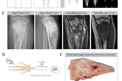 Multi-modal medical imaging and pathology analysis of tibial specimen including PET, CT, MRI scans, gross specimen photography, NIR fluorescence imaging, and histological staining