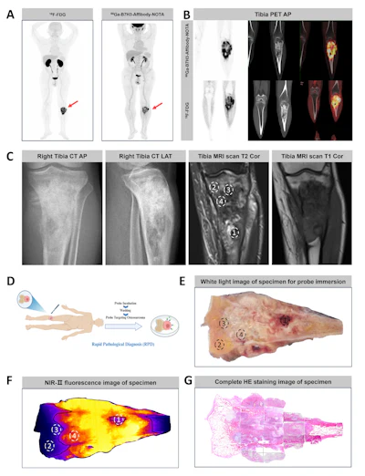 (A-C) Representative whole-body maximum-intensity projection images and regional fused PET/CT images from three histologically confirmed osteosarcoma patients who underwent paired [68Ga]Ga-B7-H3-BCH PET/CT and 18F-FDGE PET/CT within seven days. (D) Multimodal imaging evaluation of Patient Three, including x-ray, MRI (T2-weighted imaging, T2WI), CT, and B7-H3 PET/CT.