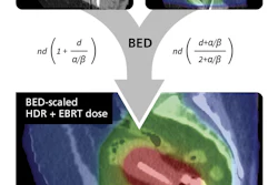 MIM ComboTherapy GYN HDR/EBRT provides a visual and quantitative approach to dose summation across treatment modalities.