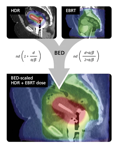 MIM ComboTherapy GYN HDR/EBRT provides a visual and quantitative approach to dose summation across treatment modalities.