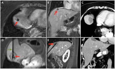 A and B: T1-weighted MRI (portal venous phase) show a 16 mm hepatic metastasis (red arrow), with a minimum distance of 0 mm to the diaphragm. D and E: Immediate post-ablation T1-weighted MRI (portal venous phase) in reformatted orientation along the antenna trajectory (green arrow) demonstrates complete tumor necrosis. C and F: CT images (portal venous phase) acquired 20 months post-ablation reveal the remaining ablation zone without evidence of residual/recurrent tumor.