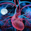Pacemaker Heart 400