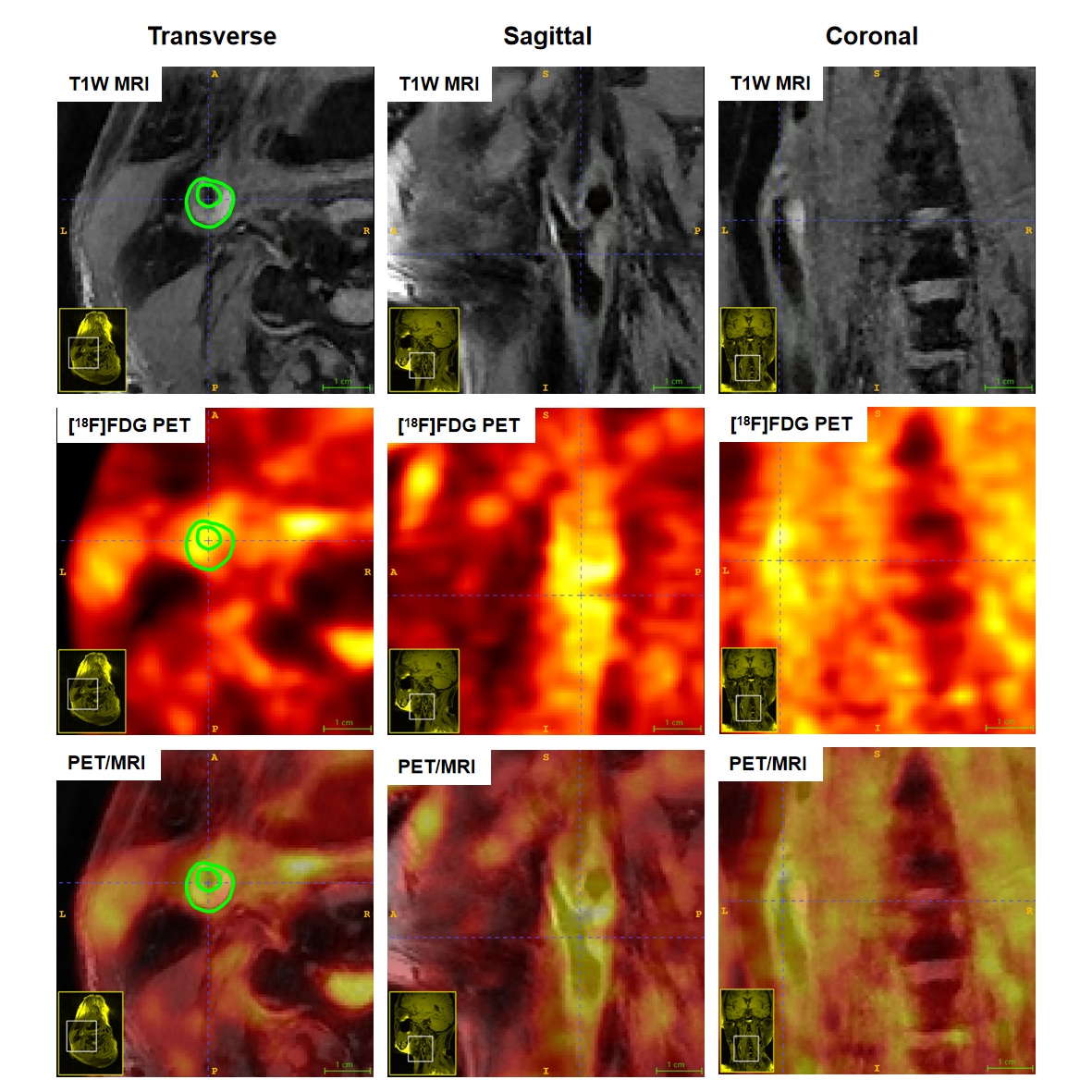 Multimodality imaging (MRI, PET, and fused PET/MRI) of carotid artery plaques in asymptomatic and symptomatic subjects, illustrating distinct features of surface ulceration, plaque enhancement, metabolic uptake, and SUVmax.