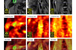 Multimodality imaging (MRI, PET, and fused PET/MRI) of carotid artery plaques in asymptomatic and symptomatic subjects, illustrating distinct features of surface ulceration, plaque enhancement, metabolic uptake, and SUVmax.