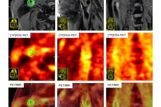 Multimodality imaging (MRI, PET, and fused PET/MRI) of carotid artery plaques in asymptomatic and symptomatic subjects, illustrating distinct features of surface ulceration, plaque enhancement, metabolic uptake, and SUVmax.