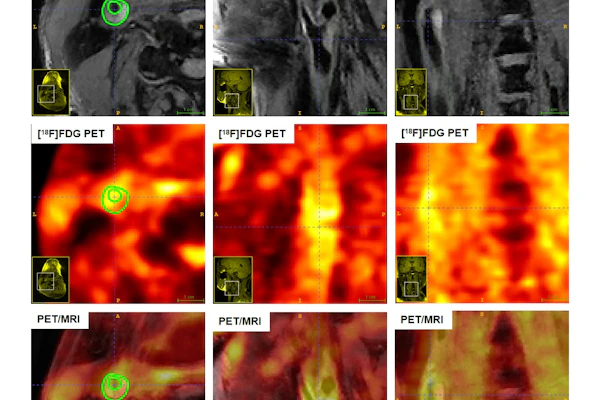 Multimodality imaging (MRI, PET, and fused PET/MRI) of carotid artery plaques in asymptomatic and symptomatic subjects, illustrating distinct features of surface ulceration, plaque enhancement, metabolic uptake, and SUVmax.
