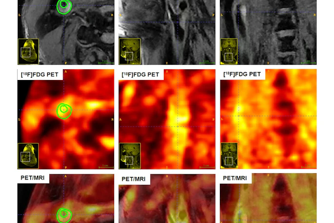 Multimodality imaging (MRI, PET, and fused PET/MRI) of carotid artery plaques in asymptomatic and symptomatic subjects, illustrating distinct features of surface ulceration, plaque enhancement, metabolic uptake, and SUVmax.