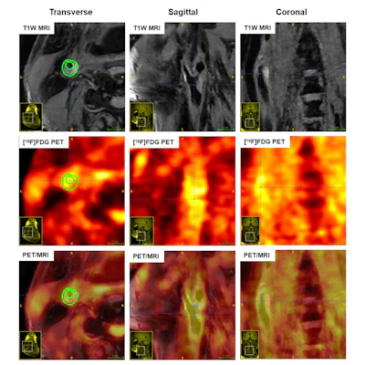 Multimodality imaging (MRI, PET, and fused PET/MRI) of carotid artery plaques in asymptomatic and symptomatic subjects, illustrating distinct features of surface ulceration, plaque enhancement, metabolic uptake, and SUVmax.