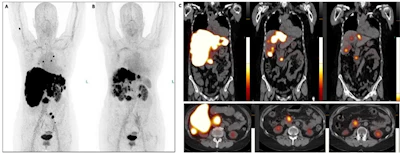 An example of partial response. 58-year-old patient with neuroendocrine neoplasm of the pancreas with hepatic and bone metastases. Previously treated with chemotherapy, hemithyroidectomy, PRRT with 177Lu-DOTATATE, Lanreotide, Everolimus, trans-arterial chemo-embolization of liver metastases. After two cycles of tandem DOTA-LM3 PRRT, she achieved partial remission of disease (reduced hepatic and bone metastases). PRRT resulted in improved quality of life, including reduced abdominal pain and enhanced physical activity. Delayed side effects include anemia G2 and reduced platelets count G3. A) 68Ga-DOTA-LM3 PET/CT scan pre-PRRT in July 2023. B) 68Ga-DOTA-LM3 PET/CT scan post-PRRT (1x tandem DOTA-LM3 PRRT with 225AC and 177Lu) in September 2023. C) PET/CT images (from left to right) pre-PRRT in July 2023, post-first cycle of tandem PRRT in September 2023, and post-second cycle of tandem PRRT (November 2023). The images show the reduced uptake and dimension of the tumoral lesions.