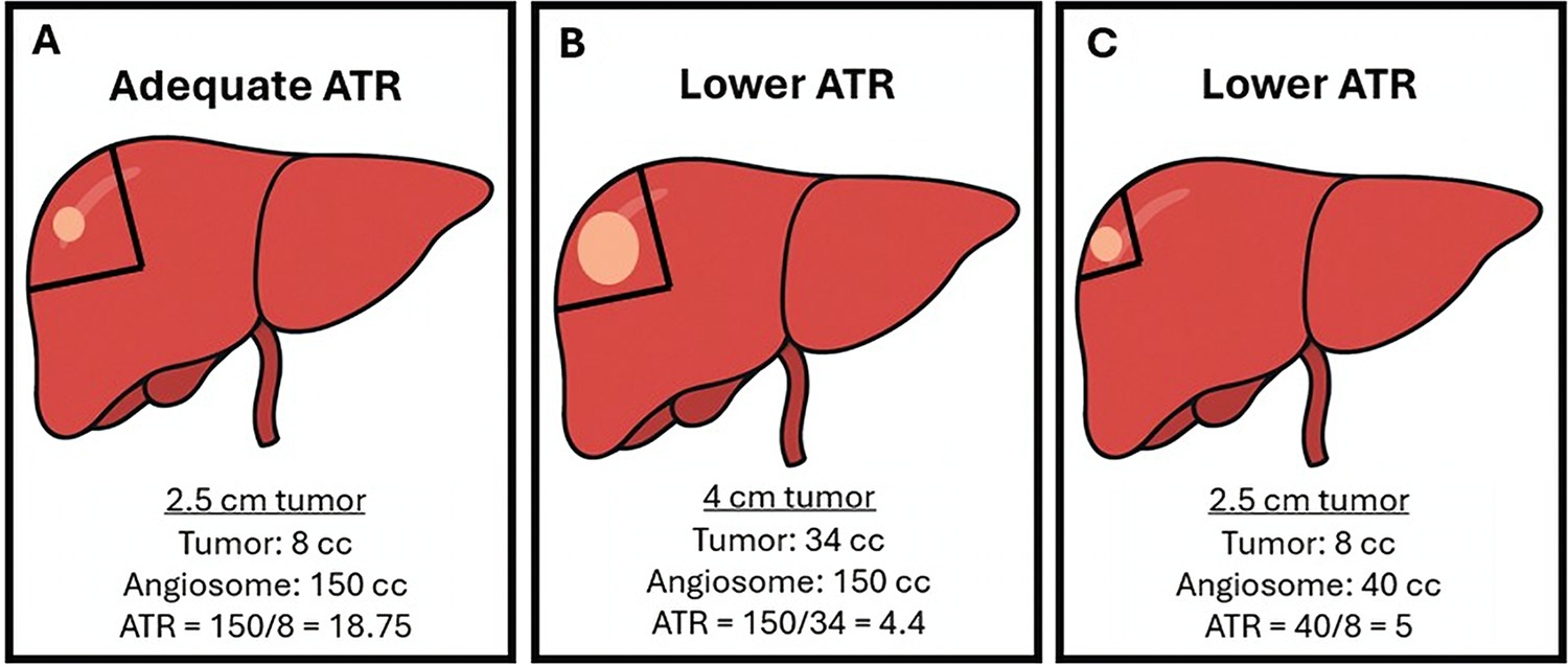 Illustrations show the role of angiosome-to-tumor volume ratio (ATR) in different clinical scenarios based on tumor and treatment angiosome volume. The pale orange oval represents the tumor within the liver, and the pie-shaped region encompassed by the black lines represents the angiosome. (A) An adequate ATR (&ge;16) is reached when treating tumor and an accompanying appropriate volume of expendable surrounding normal parenchyma, such as a 2.5-cm tumor within a 150-mL treatment angiosome. Lower (inadequate) ATR can occur with superselective administrations, such as (B) attempting to treat a larger (4-cm) tumor within the same 150-mL angiosome, which proves suboptimal, and (C) attempting to treat the same 2.5-cm tumor within a reduced angiosome (40 mL).