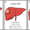 Illustrations show the role of angiosome-to-tumor volume ratio (ATR) in different clinical scenarios based on tumor and treatment angiosome volume. The pale orange oval represents the tumor within the liver, and the pie-shaped region encompassed by the black lines represents the angiosome. (A) An adequate ATR (≥16) is reached when treating tumor and an accompanying appropriate volume of expendable surrounding normal parenchyma, such as a 2.5-cm tumor within a 150-mL treatment angiosome. Lower (inadequate) ATR can occur with superselective administrations, such as (B) attempting to treat a larger (4-cm) tumor within the same 150-mL angiosome, which proves suboptimal, and (C) attempting to treat the same 2.5-cm tumor within a reduced angiosome (40 mL).