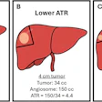Illustrations show the role of angiosome-to-tumor volume ratio (ATR) in different clinical scenarios based on tumor and treatment angiosome volume. The pale orange oval represents the tumor within the liver, and the pie-shaped region encompassed by the black lines represents the angiosome. (A) An adequate ATR (≥16) is reached when treating tumor and an accompanying appropriate volume of expendable surrounding normal parenchyma, such as a 2.5-cm tumor within a 150-mL treatment angiosome. Lower (inadequate) ATR can occur with superselective administrations, such as (B) attempting to treat a larger (4-cm) tumor within the same 150-mL angiosome, which proves suboptimal, and (C) attempting to treat the same 2.5-cm tumor within a reduced angiosome (40 mL).