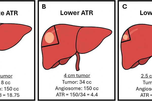 Illustrations show the role of angiosome-to-tumor volume ratio (ATR) in different clinical scenarios based on tumor and treatment angiosome volume. The pale orange oval represents the tumor within the liver, and the pie-shaped region encompassed by the black lines represents the angiosome. (A) An adequate ATR (≥16) is reached when treating tumor and an accompanying appropriate volume of expendable surrounding normal parenchyma, such as a 2.5-cm tumor within a 150-mL treatment angiosome. Lower (inadequate) ATR can occur with superselective administrations, such as (B) attempting to treat a larger (4-cm) tumor within the same 150-mL angiosome, which proves suboptimal, and (C) attempting to treat the same 2.5-cm tumor within a reduced angiosome (40 mL).