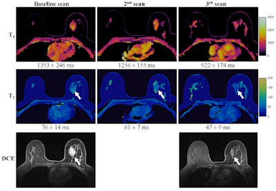 Representative dynamic contrast enhanced (DCE)-MRI and MRF T1 and T2 maps obtained from a 52-year-old responder with invasive ductal carcinoma scanned at three time points. The DCE images acquired at both the baseline and third MRF scan are presented. The mean and standard deviation of the quantitative T1 and T2 values extracted from the region of interest analysis are shown at the bottom of the maps.