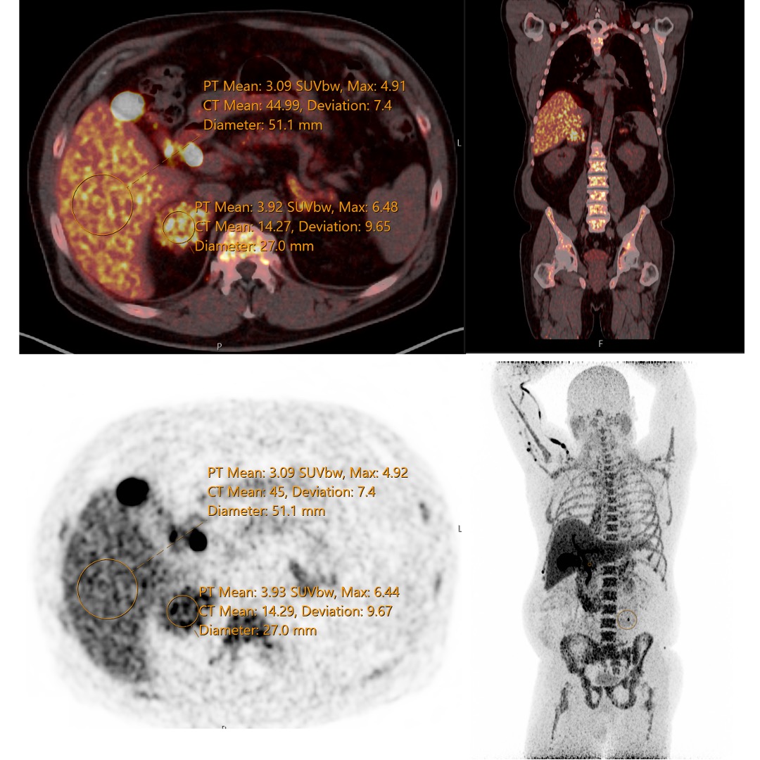 Static PET-CT image of patient with hypercortisolism taken at 60 minutes post-injection.