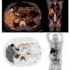 Static PET-CT image of patient with hypercortisolism taken at 60 minutes post-injection.