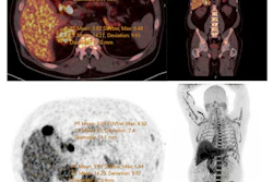 Static PET-CT image of patient with hypercortisolism taken at 60 minutes post-injection.