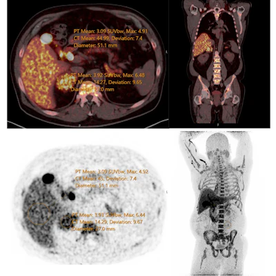 Static PET-CT image of patient with hypercortisolism taken at 60 minutes post-injection.