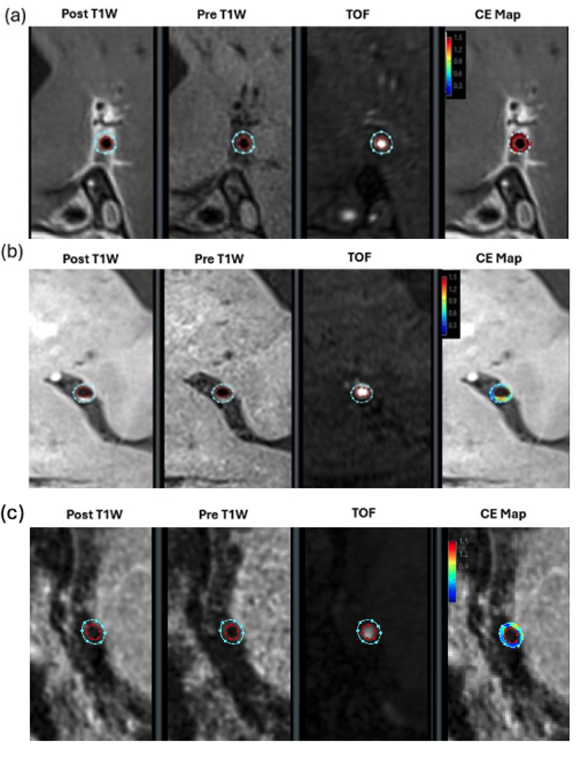 Software analysis shows distribution, contours, and contrast enhancement. (a)Vasculitis lesion showing diffuse concentric enhancement, (b) atherosclerotic plaque showing eccentric wall thickening and less enhancing volume, (c) RCVS showing lower percent wall volume.
