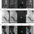 Software analysis shows distribution, contours, and contrast enhancement. (a)Vasculitis lesion showing diffuse concentric enhancement, (b) atherosclerotic plaque showing eccentric wall thickening and less enhancing volume, (c) RCVS showing lower percent wall volume.