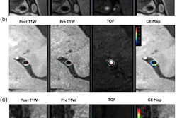Software analysis shows distribution, contours, and contrast enhancement. (a)Vasculitis lesion showing diffuse concentric enhancement, (b) atherosclerotic plaque showing eccentric wall thickening and less enhancing volume, (c) RCVS showing lower percent wall volume.