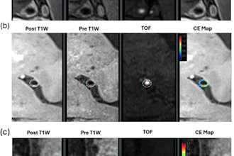 Software analysis shows distribution, contours, and contrast enhancement. (a)Vasculitis lesion showing diffuse concentric enhancement, (b) atherosclerotic plaque showing eccentric wall thickening and less enhancing volume, (c) RCVS showing lower percent wall volume.